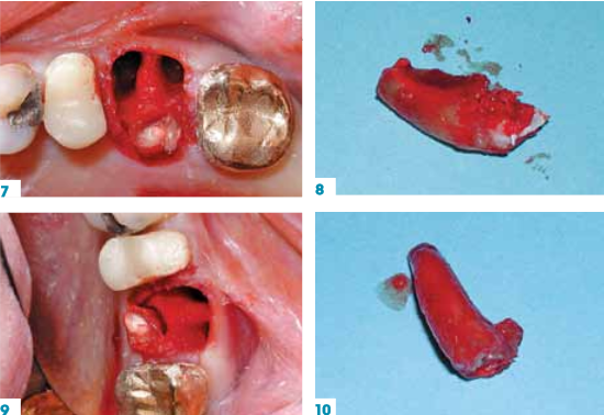 tooth extraction 2