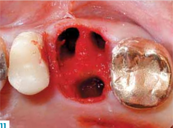 tooth extraction 3