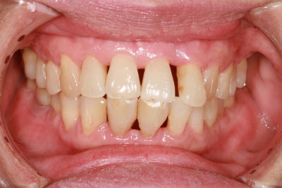 Gingival recession-When is referral necessary?