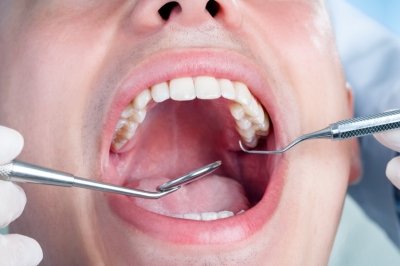 What Is Dental Fluorosis?